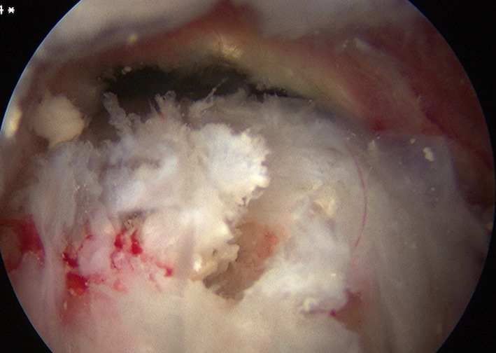 Calcium in Tendon